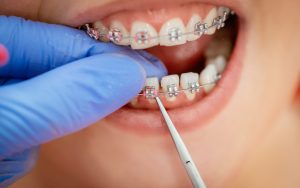 Orthodontic Braces Treatment | Tower House Dental Clinic