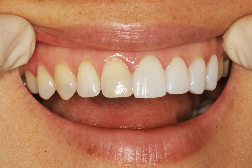 Veneers in Agoura Hills