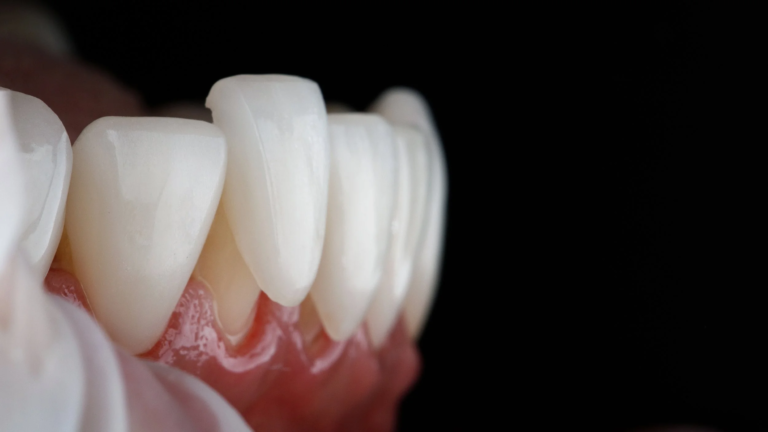 Porcelain Veneer or Crown for a Front Tooth: Which Makes Sense?