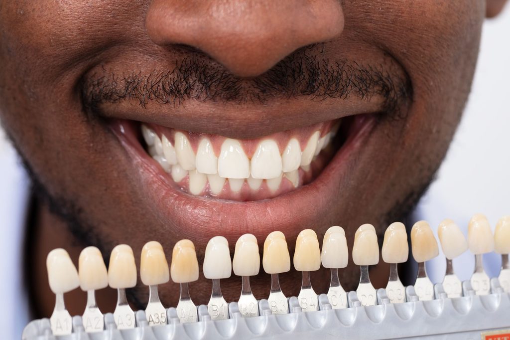 Dental Veneers